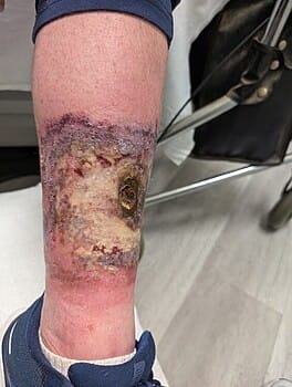 My leg with a serious bacterial infection