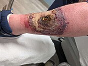 Picture of Party Favorz leg with an infection including 90% deadskin around a massive hole in the shin