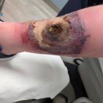 Picture of Party Favorz leg with an infection including 90% deadskin around a massive hole in the shin