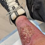 My leg after debridment and newly infected again