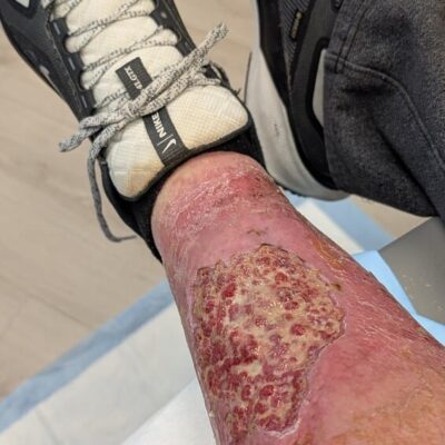 My leg after debridment and newly infected again