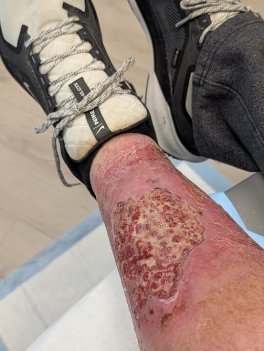 My leg after debridment and newly infected again