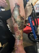 Pyoderma gangrenosum infection