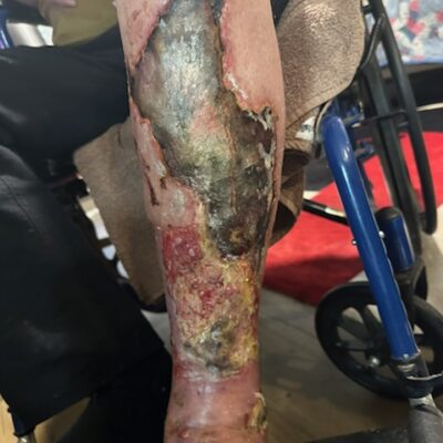 Pyoderma gangrenosum infection