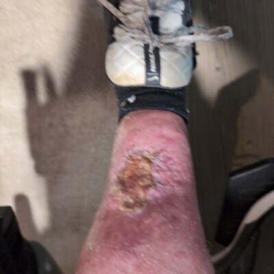 healing wound with skin growth