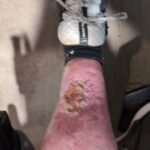 healing wound with skin growth