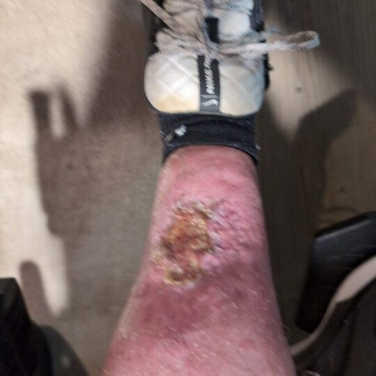 healing wound with skin growth